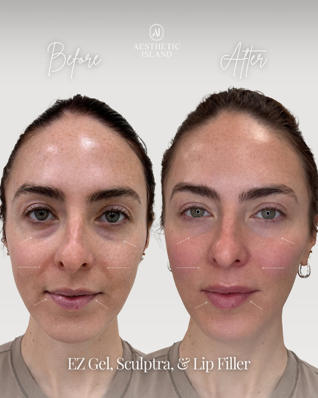 Full Face Rejuvenation before and after treatment result