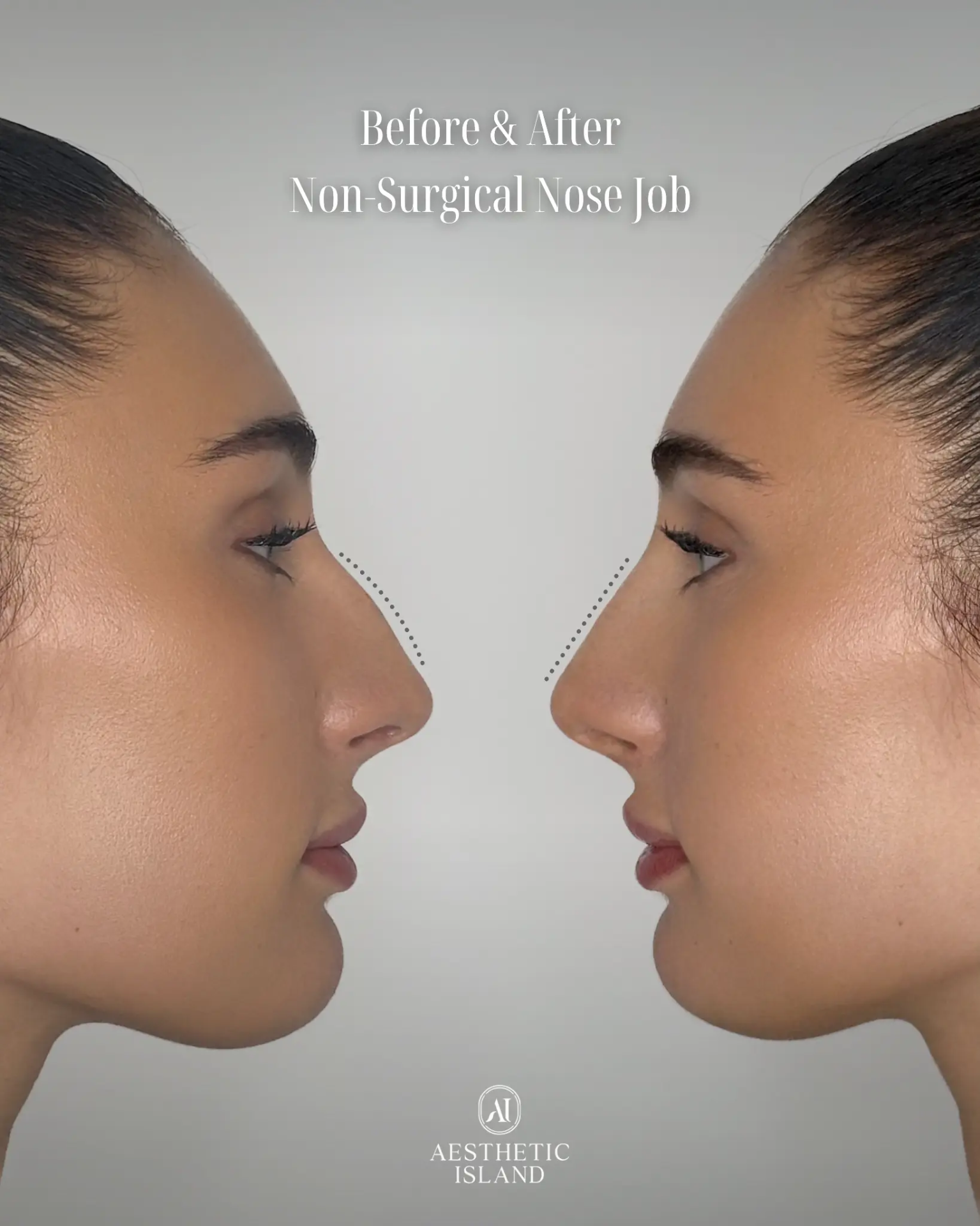 Non-Surgical Nose Job before and after treatment result