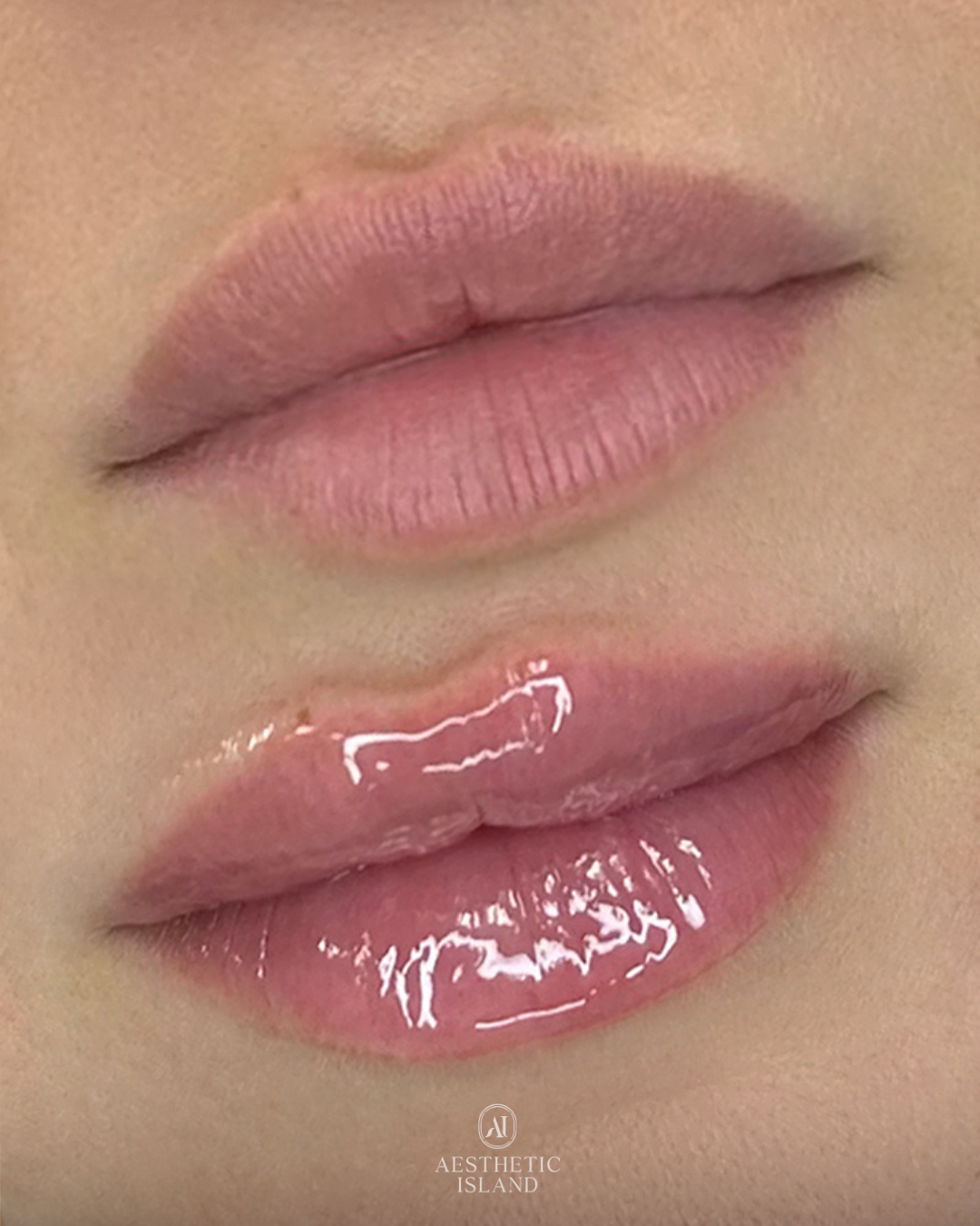 Signature Lip Filler before and after treatment result