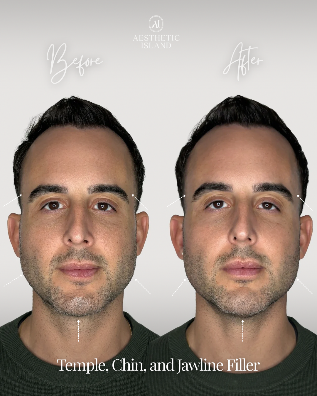 Temple, Chin & Jawline before and after treatment result
